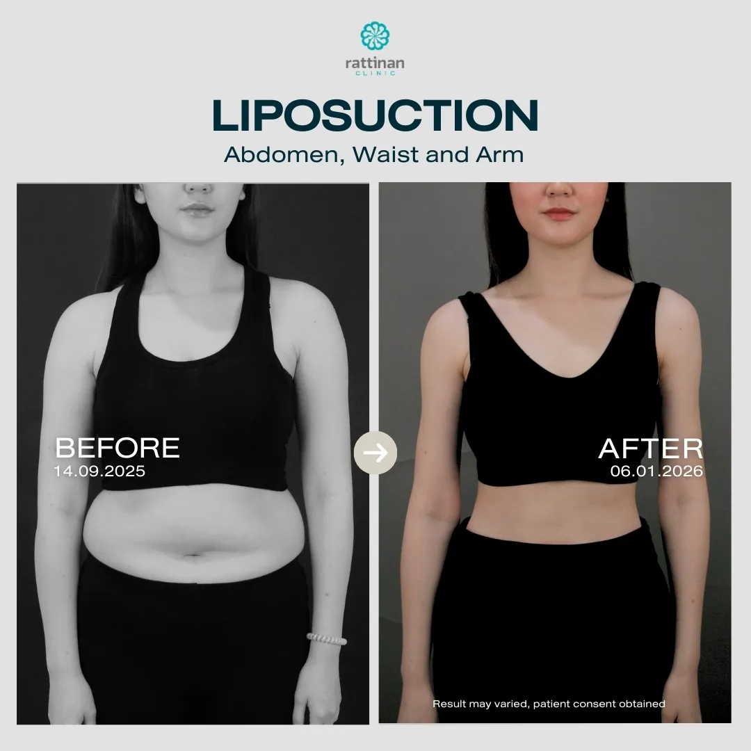liposuction-before-after-01