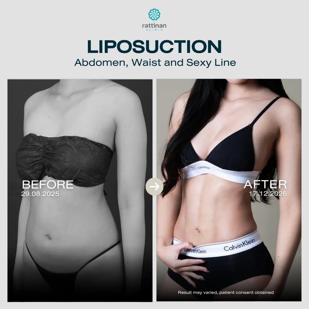 liposuction-before-after-03