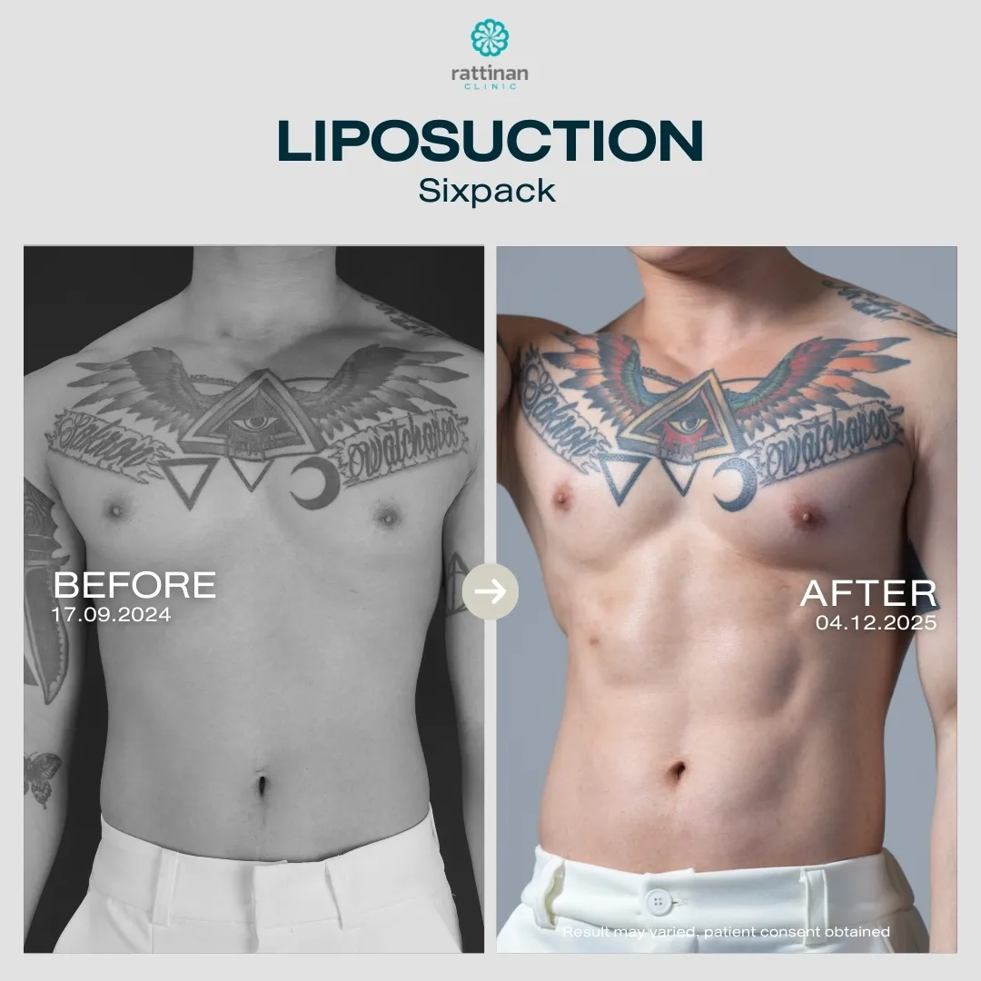 liposuction-before-after-04