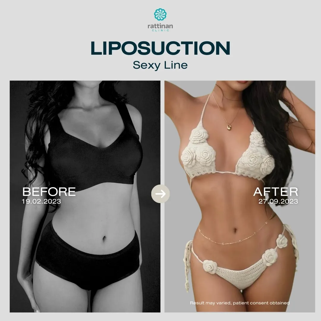 liposuction-before-after-05