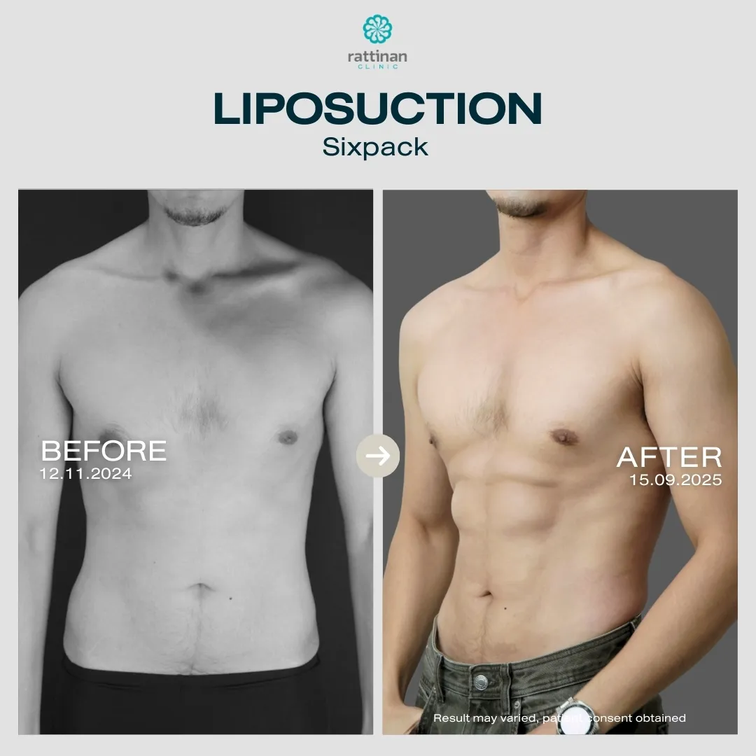 liposuction-before-after-06