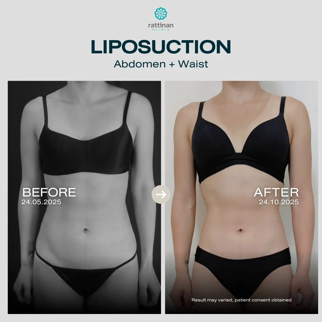 liposuction-before-after-07