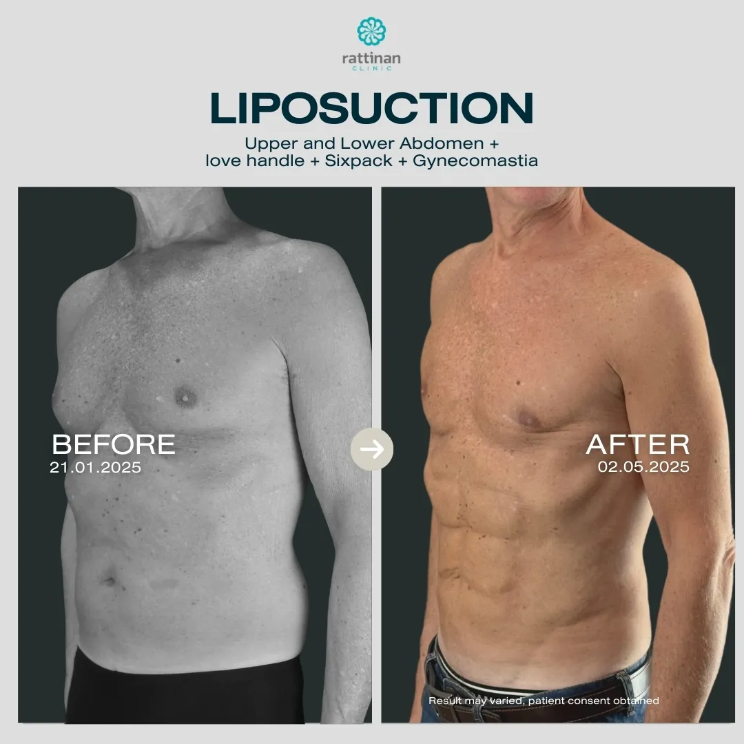 liposuction-before-after-08