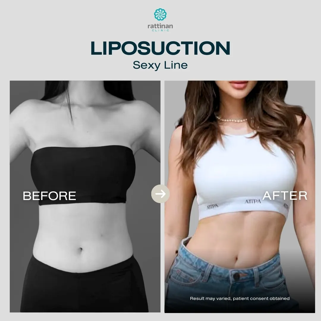 liposuction-before-after-09