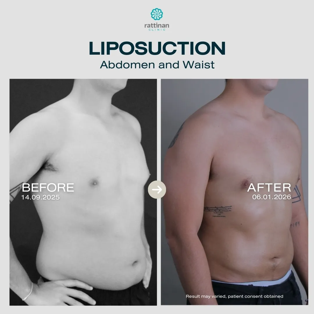 liposuction-before-after-10