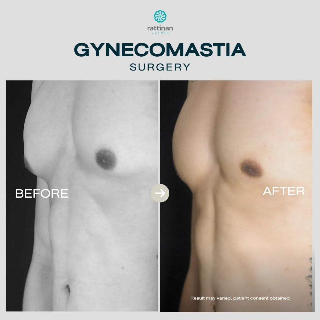 gyno-before-after-001