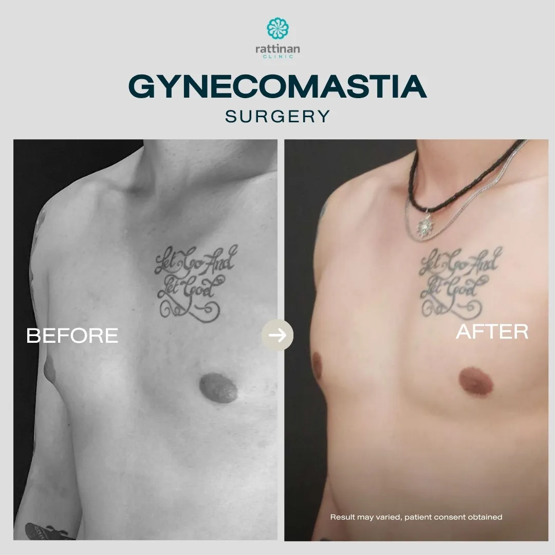 gyno-before-after-002