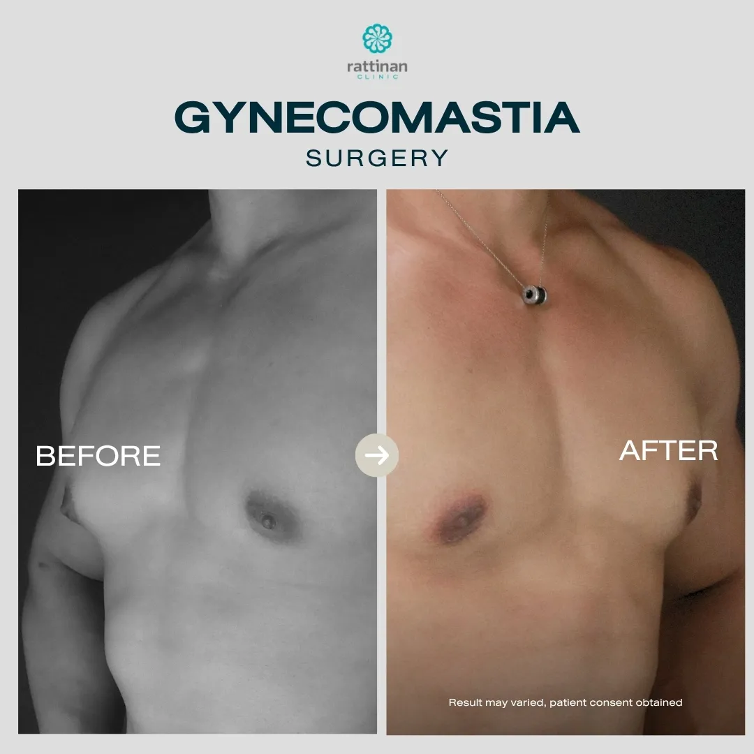 gyno-before-after-003