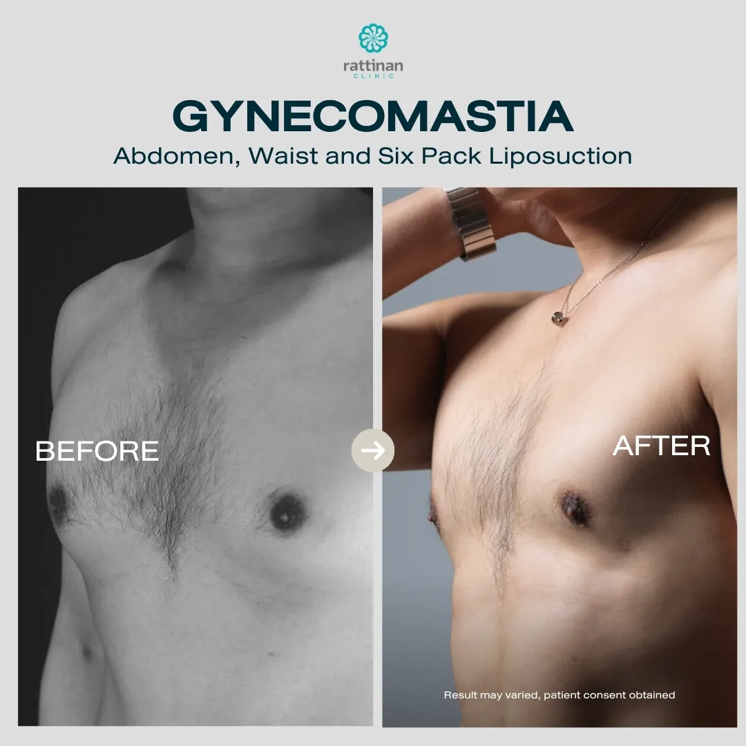 gyno-before-after-004
