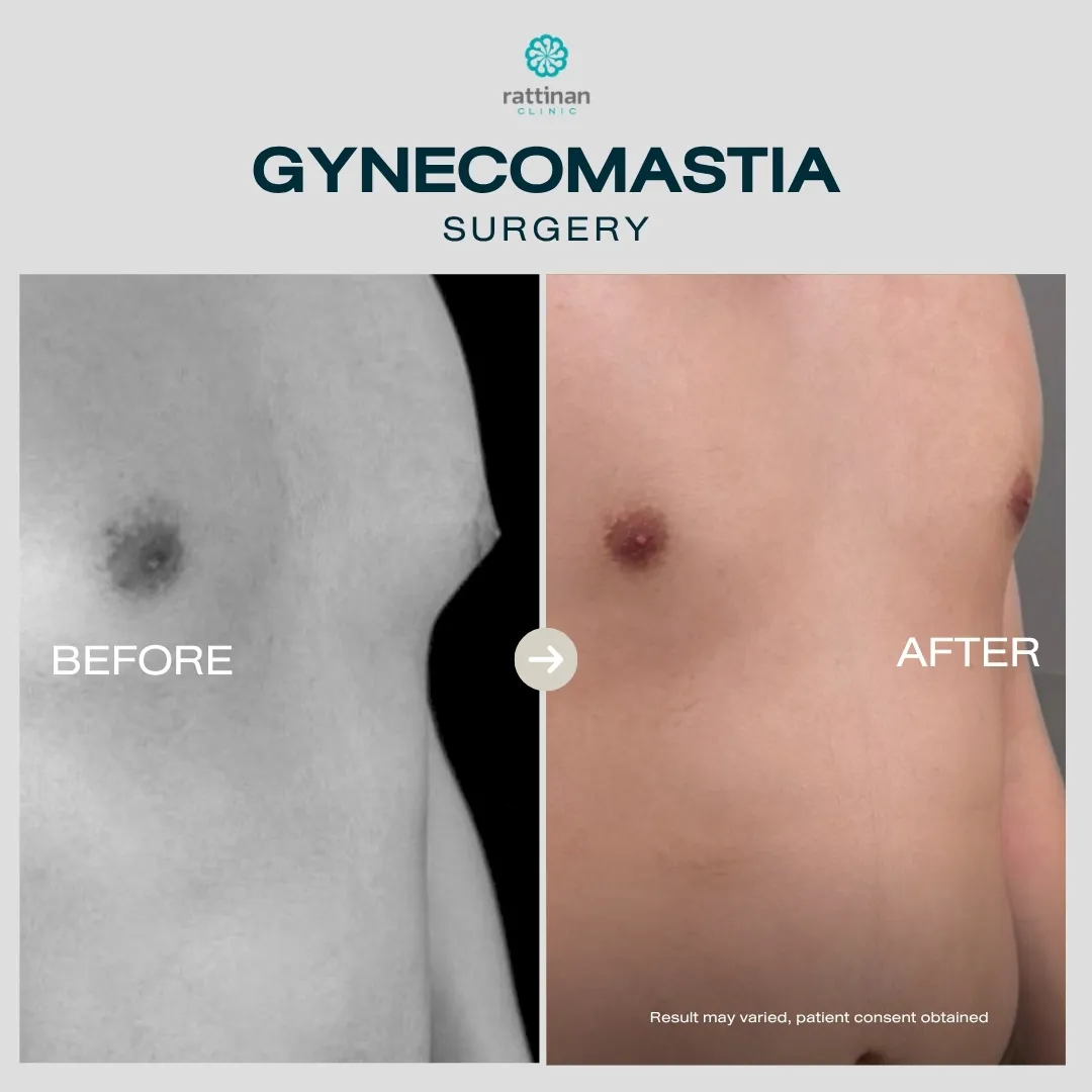 gyno-before-after-005