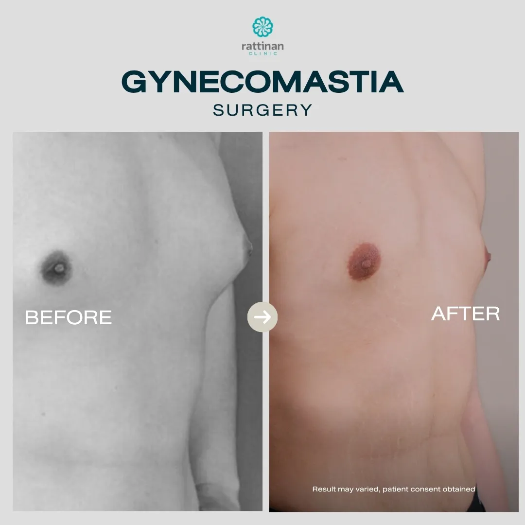 gyno-before-after-006