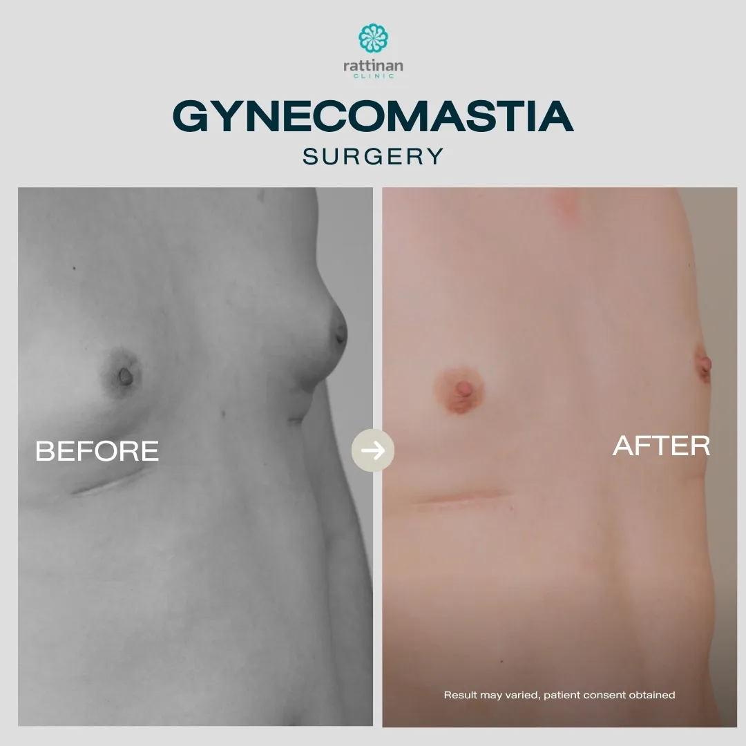 gyno-before-after-007