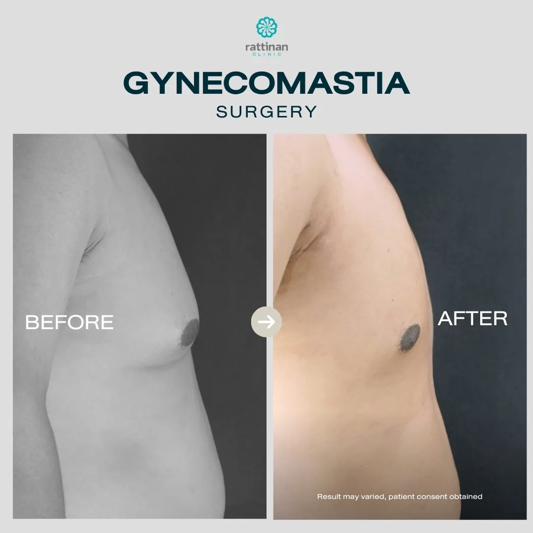 gyno-before-after-008
