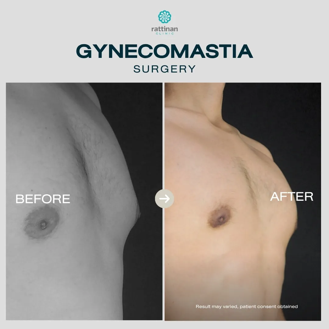 gyno-before-after-010